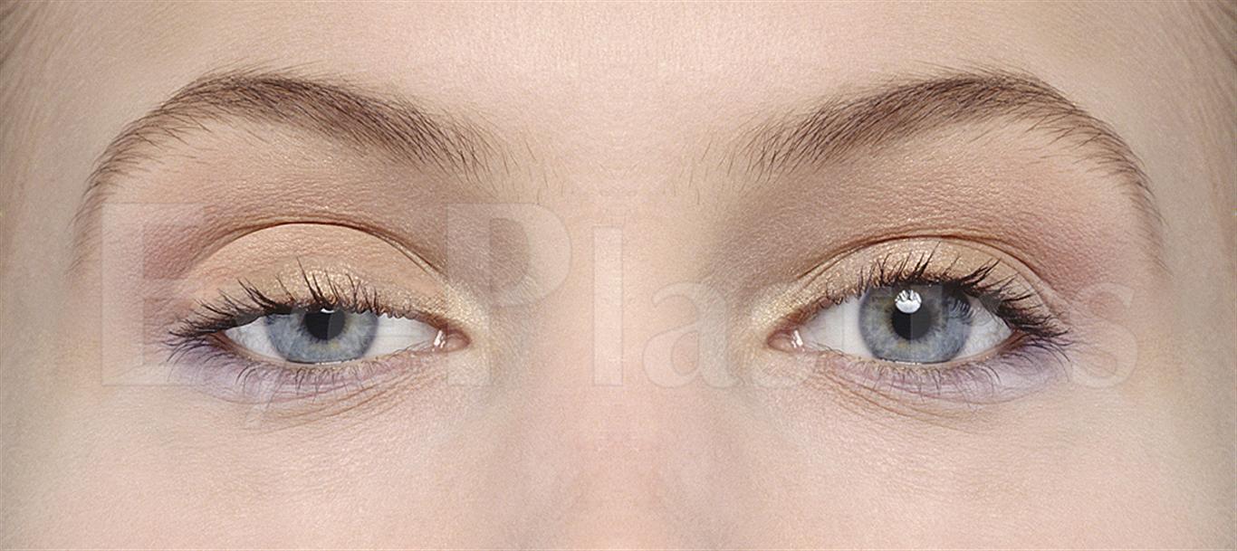 Ptosis Surgery Droopy Eyelid Lazy Eyelid Acquired Ptosis Congenital Ptosis 